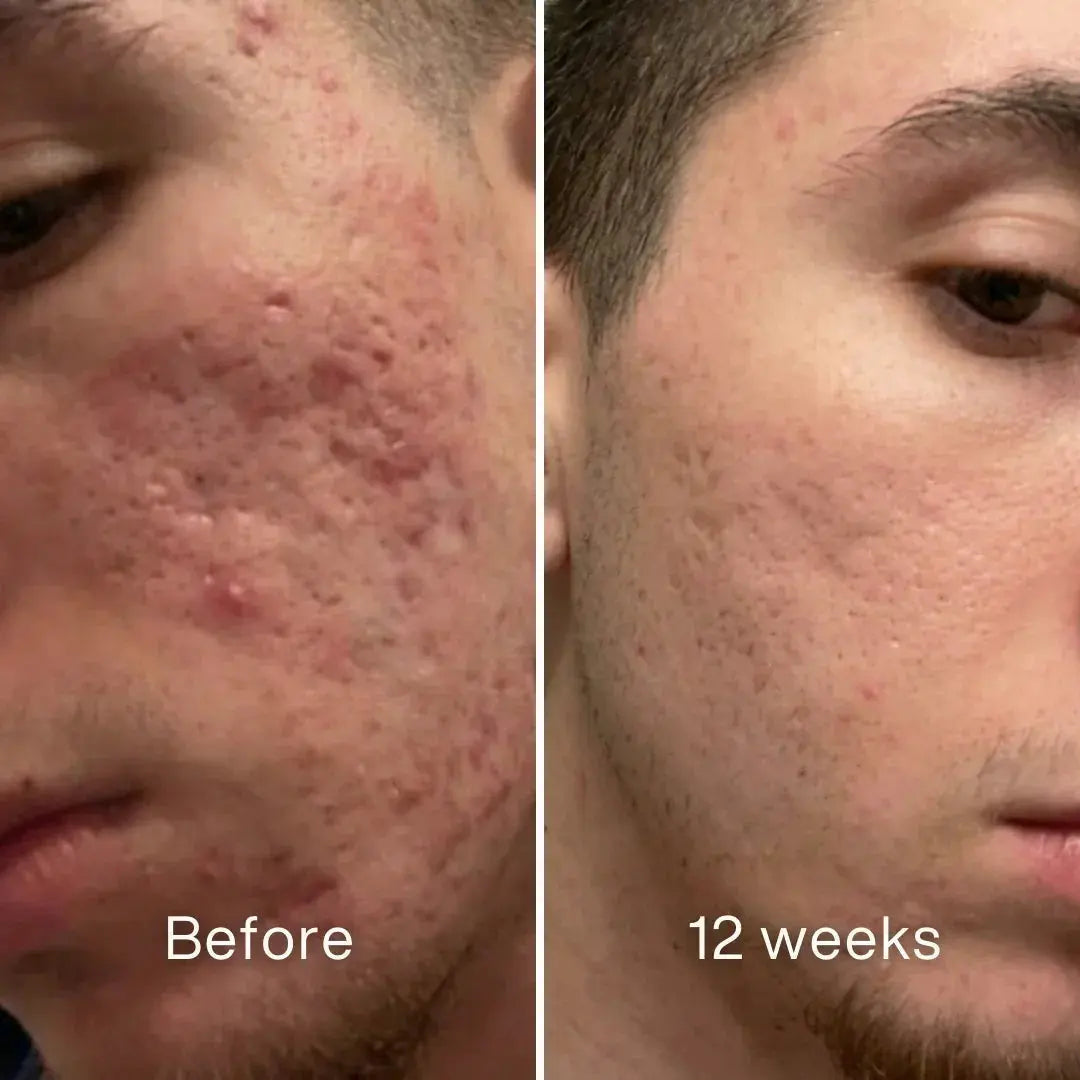 Evina™ Scar Repair Stick