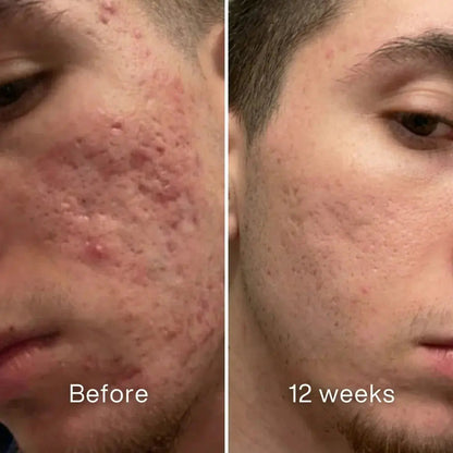 Evina™ Scar Repair Stick