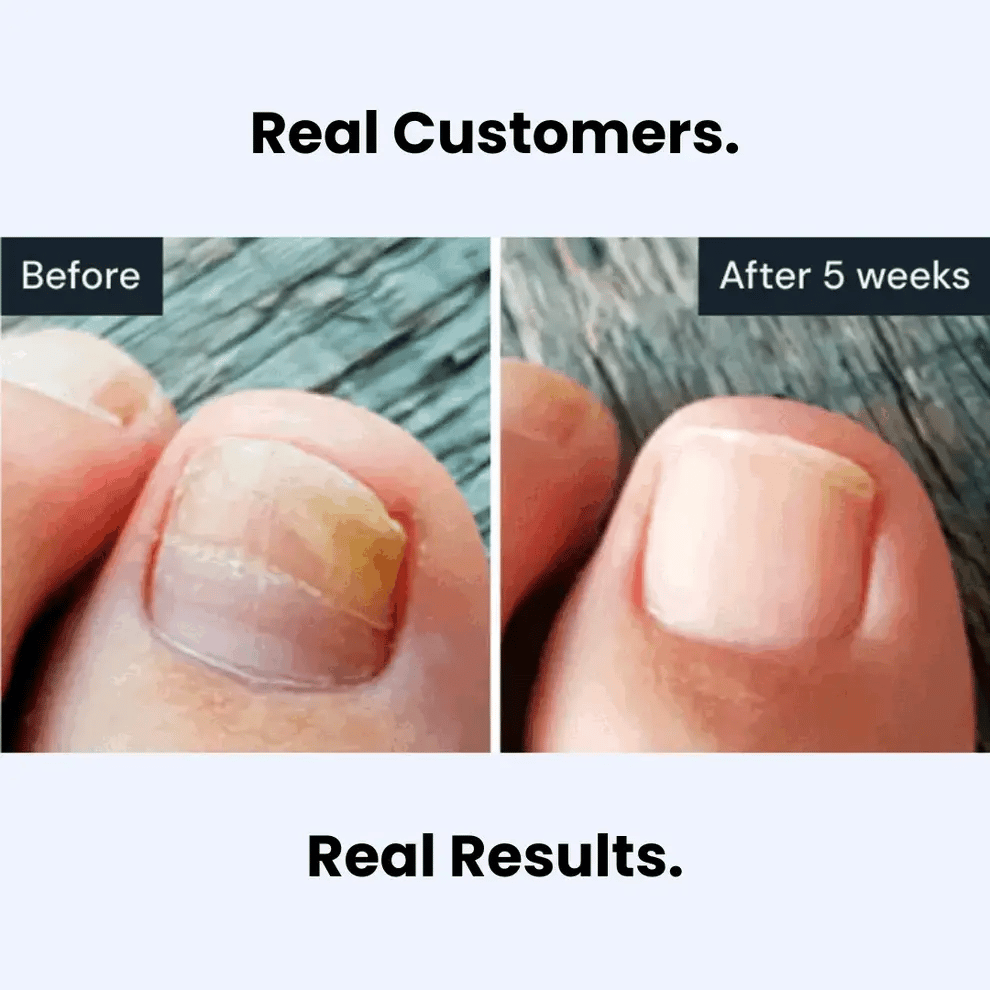 Evina™ Anti-fungal Pen