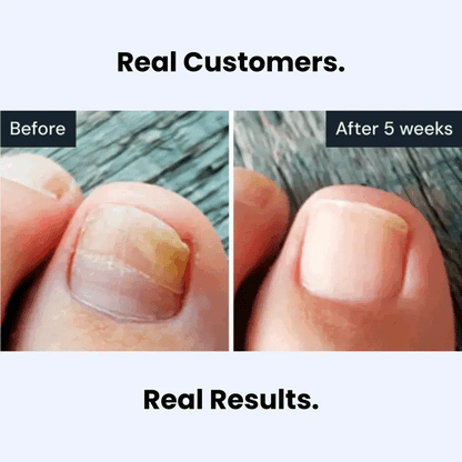 Evina™ Anti-fungal Pen